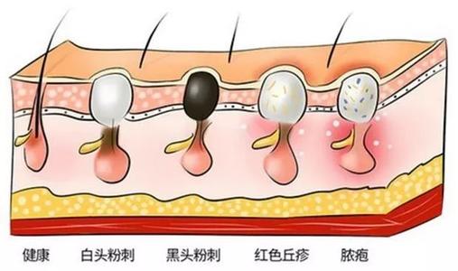 黑头怎样形成的 温和去黑头方法 用什么产品去黑头效果好